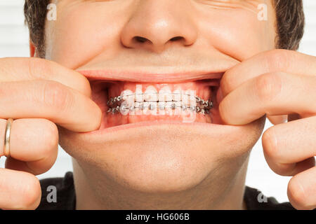 Close-up picture of man showing dental braces Stock Photo