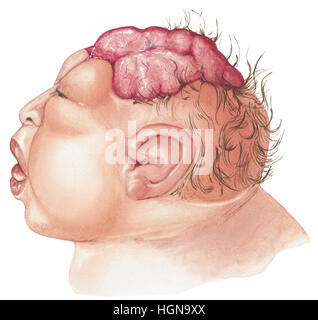A newborn baby with anencephaly showing the brain protruding through the skull. Stock Photo