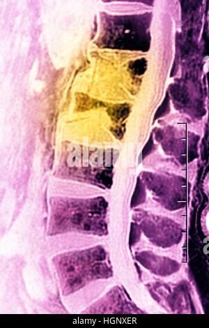 COMPRESSION FRACTURE, MRI Stock Photo