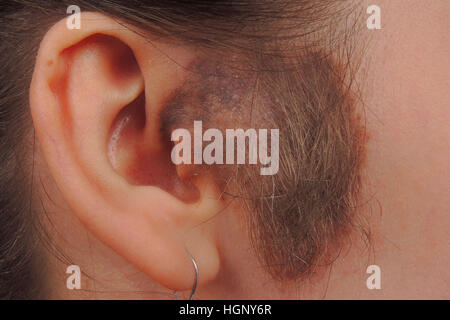 CUTANEOUS HAMARTOMA Stock Photo - Alamy