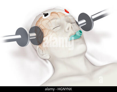 ELECTROSHOCK, ILLUSTRATION Stock Photo