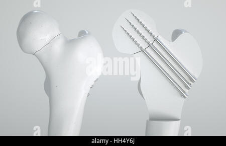 Fracture of the femur - Treatment with screws - 3D Rendering Stock Photo