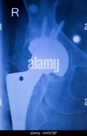 Hip joint replacement xray showing ball and socket joint's titanium screw implant in medical orthpodedics scan. Stock Photo