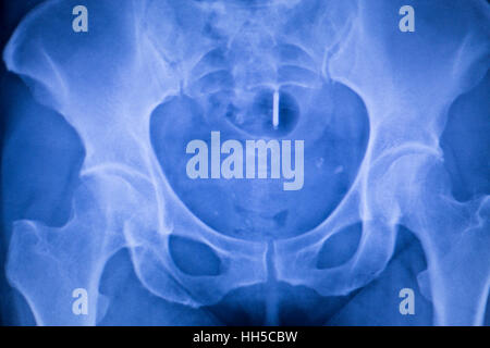 Hip joint replacement xray showing ball and socket joint's titanium screw implant in medical orthpodedics scan. Stock Photo