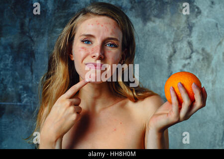 Young woman have allergy on orange. Face have a lot of acne and she is very unhappy. Stock Photo