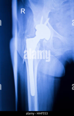 Hip joint replacement xray showing ball and socket joint's titanium screw implant in medical orthpodedics scan. Stock Photo