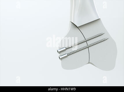 Fracture of the femur - Treatment with screws - 3D Rendering Stock Photo