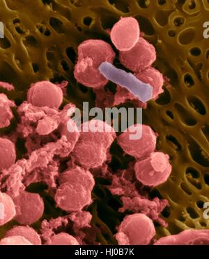 Bacteria on an epithelial cell from the human tongue filiform papilla, coloured scanning electron micrograph (SEM). Coccoid bacteria (likely Streptococcus mutans due to the fibrous glucan matrix that surrounds the cells) and one rod bacterium are seen on the epithelial surface. Most bacteria on the human tongue are harmless or even beneficial. However some bacteria can cause throat infections and form plaque deposits on teeth. Plaque will also lead to tooth decay and periodontal disease. Magnification: x5, 000 when shortest axis printed at 25 millimetres. Stock Photo