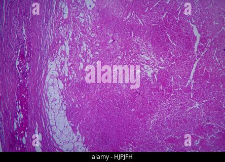 This micrograph depicts the histopathologic changes associated with cryptococcosis of an adrenal gland, 1964. Cryptococcosis is transmitted through inhalation of airborne yeast cells and/or biospores. People at risk for this disease are immunocompromised, especially those with HIV infection. Image courtesy CDC/Dr. Martin Hicklin. Stock Photo