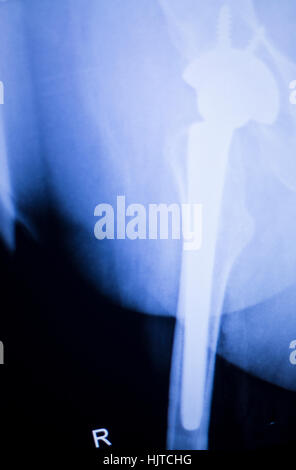 Hip joint replacement xray showing ball and socket joint's titanium screw implant in medical orthpodedics scan. Stock Photo