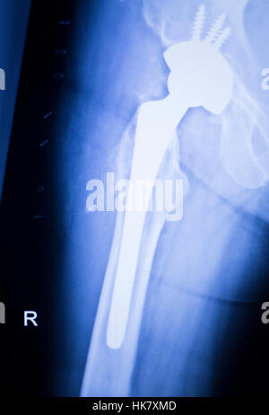 Hip joint replacement xray showing ball and socket joint's titanium screw implant in medical orthpodedics scan. Stock Photo