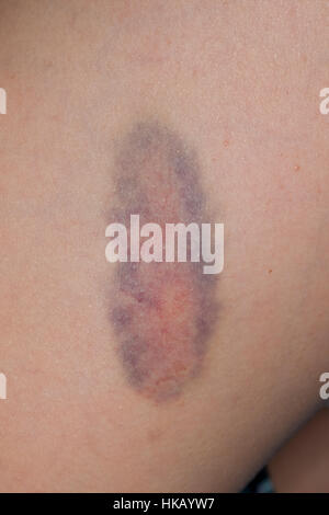 Blauer Fleck, Hämatom, Bluterguss, Bluterguß,  Prellung, Kind hat sich am Bein gestoßen, haematoma, hematoma, bruise Stock Photo