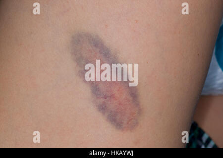 Blauer Fleck, Hämatom, Bluterguss, Bluterguß,  Prellung, Kind hat sich am Bein gestoßen, haematoma, hematoma, bruise Stock Photo