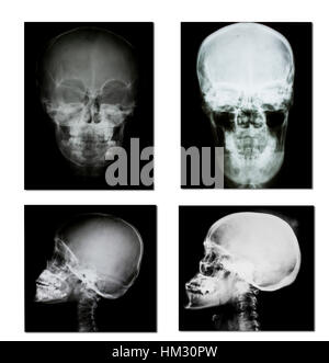 collection of x-ray (head x-ray image) Stock Photo