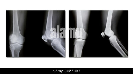 collection of x-ray (broken knee, normal knee) Stock Photo