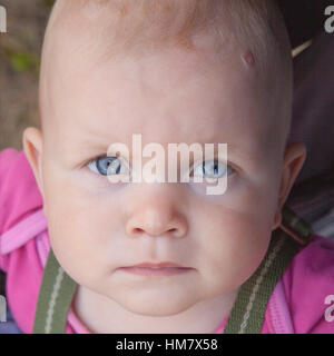Close up portrait of baby girl with blue eyes and hemangioma Stock Photo