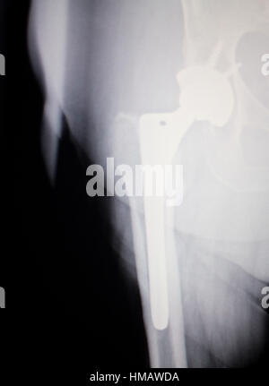 Hip joint replacement xray showing ball and socket joint's titanium screw implant in medical orthpodedics scan. Stock Photo