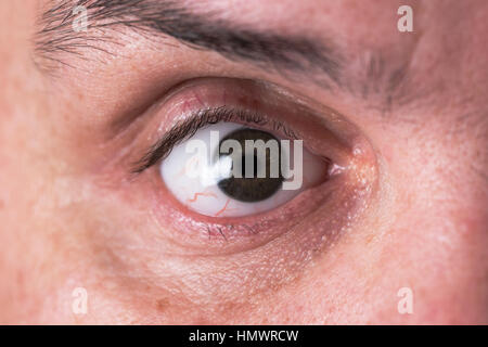 Glass eye prosthetic Ocular prosthesis Stock Photo