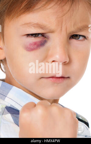 Boy with real bruise Stock Photo