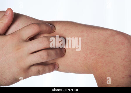 Scratching hand with allergy rash isolated on white Stock Photo