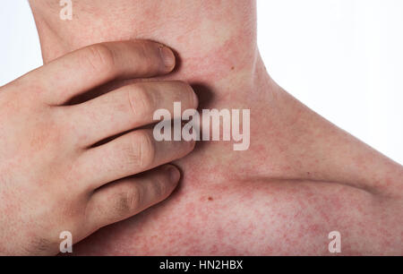 man scratching his neck with rash isolated on white Stock Photo