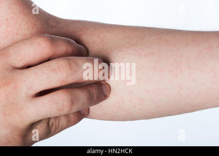 close up of hand with rash isolated on white Stock Photo