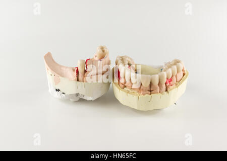 denture made of ceramics located on plaster model Stock Photo