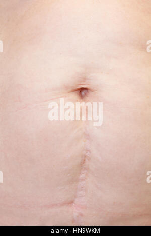 Close-up of a woman with a cesarean Stock Photo