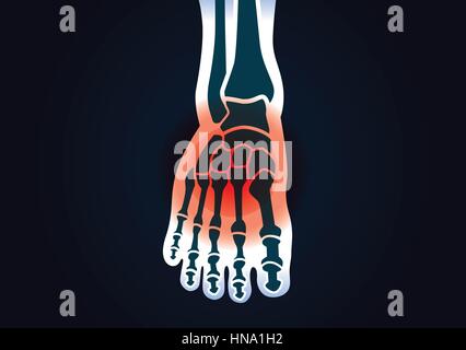 Human foot bone have a red signal. This illustration about foot pain. Stock Vector