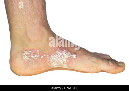 PSORIASIS ON FOOT Stock Photo - Alamy