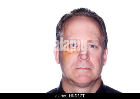 Man with shiner bruise black eye hematoma. Domestic violence male ...