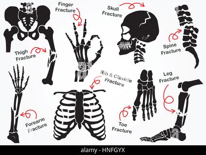 Set Bone Fracture Icon ( Pelvic , Hip , Thigh ( femur ) , Hand , Wrist , Finger , Skull , Face , Vertebra , Arm , Elbow , Thorax , Foot , Heel , Leg ) Stock Vector