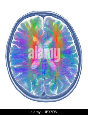 Computer artwork of MRI top view of brain showing white matter fibres ...