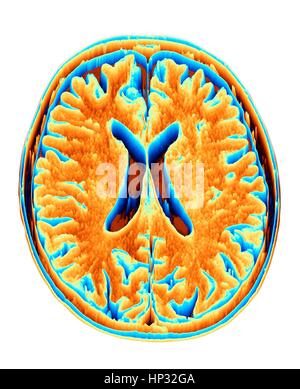 Axial brain MRI images of a normal 65 year old woman Stock Photo - Alamy