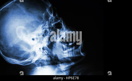 Film X-ray of normal human skull . lateral view . blank area at right side . Stock Photo