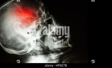 Stroke . film x-ray of human skull lateral view with stroke . blank area at right side . Stock Photo