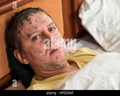 Varicella zoster virus or Chickenpox bubble rash on child, baby or adult. Closeup image of a fresh blister. Man with chickenpox. Stock Photo