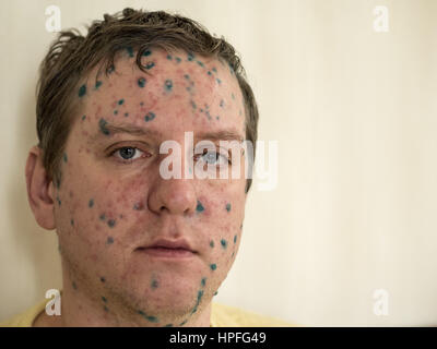 Varicella zoster virus or Chickenpox bubble rash on child, baby or adoult. Closeup image of a fresh blister. Man with chickenpox. 21st Feb, 2017. Credit: Igor Golovniov/ZUMA Wire/Alamy Live News Stock Photo