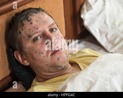 Varicella zoster virus or Chickenpox bubble rash on child, baby or adoult. Closeup image of a fresh blister. Man with chickenpox. 21st Feb, 2017. Credit: Igor Golovniov/ZUMA Wire/Alamy Live News Stock Photo