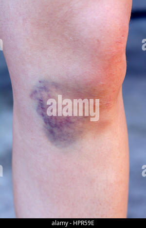 Close up of a knee with hematoma Stock Photo