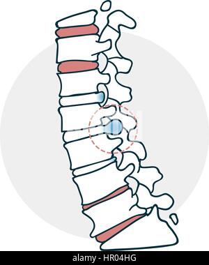 Herniated intervertebral disc icon. Icon on medical subjects. Illustration of a funny cartoon style Stock Vector