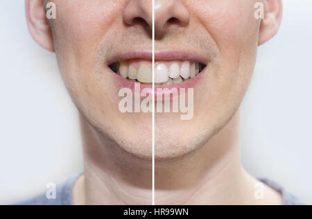 teeth before and after Stock Photo