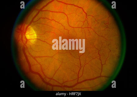 Fundus camera image (ophthalmoscope) of the retina showing acute ...