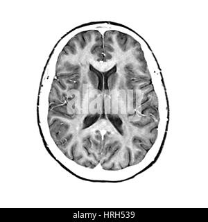 Axial brain MRI images of a normal 65 year old woman Stock Photo - Alamy