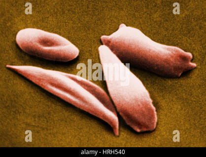 Sickle red blood cells Stock Photo