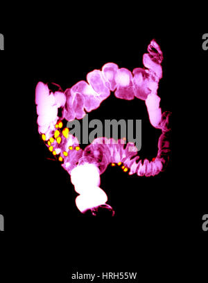 Barium Enema Showing Diverticulosis Stock Photo