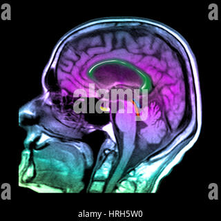 Normal Pressure Hydrocephalus Stock Photo