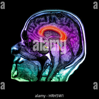 Normal Pressure Hydrocephalus Stock Photo