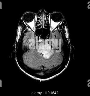 MRI of Acute MS Stock Photo