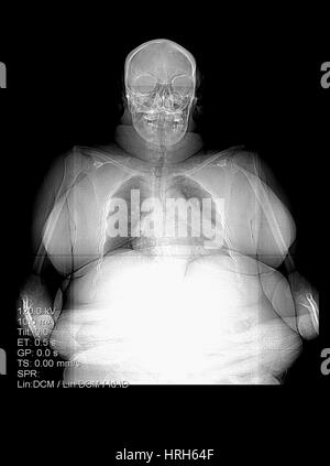 Digital X-ray of Obesity Stock Photo